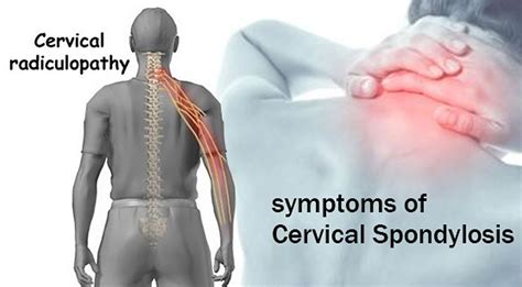 cervical spondylosis therapy